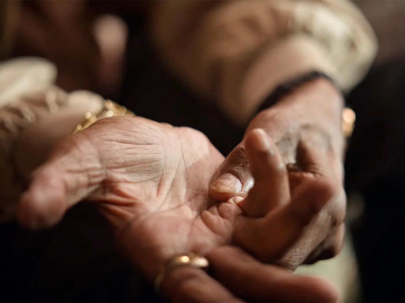 A close up of the hands of a Dupuytren's contracture patient